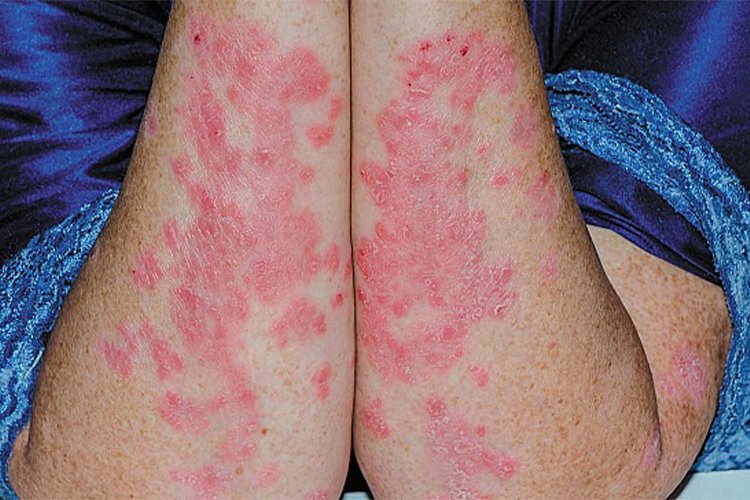 Cellulitis: How Long Does It Take to Heal on Legs?