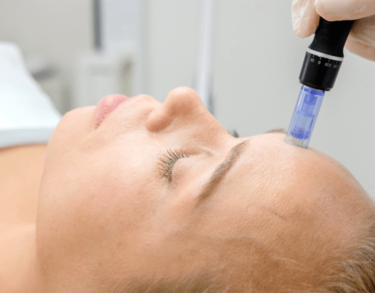 Interested in microneedling? Here's everything you need to know before booking an appointment
